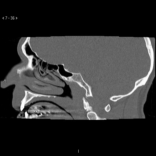 File:Antrochoanal Polyp (Radiopaedia 70510-80631 Sagittal bone window 26).jpg