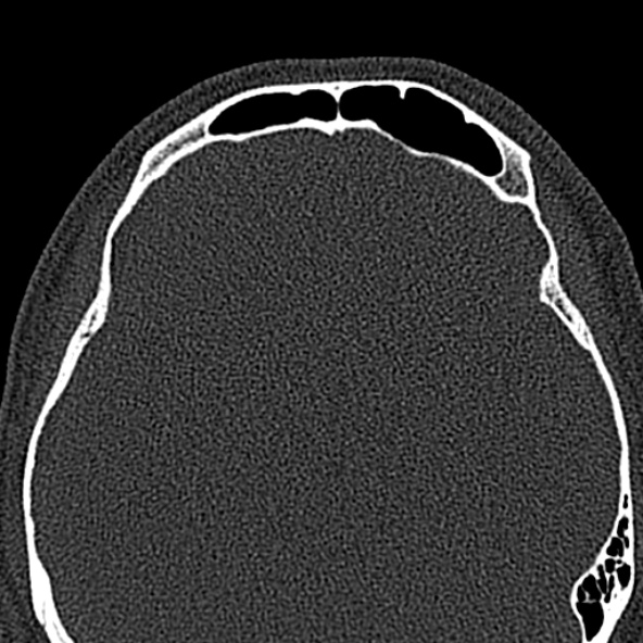 Antrochoanal polyp (Radiopaedia 30002-30554 Axial bone window 52).jpg