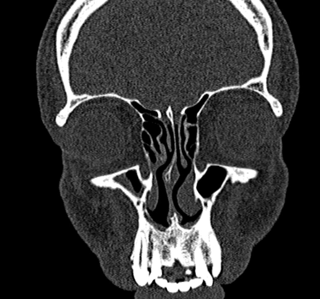Antrochoanal polyp (Radiopaedia 30002-30554 Coronal bone window 25).jpg