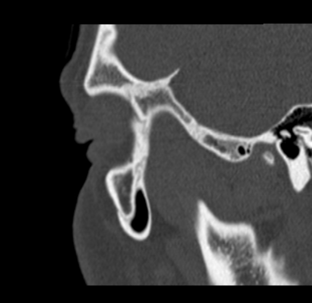 Antrochoanal polyp (Radiopaedia 33984-35202 Sagittal bone window 79).jpg
