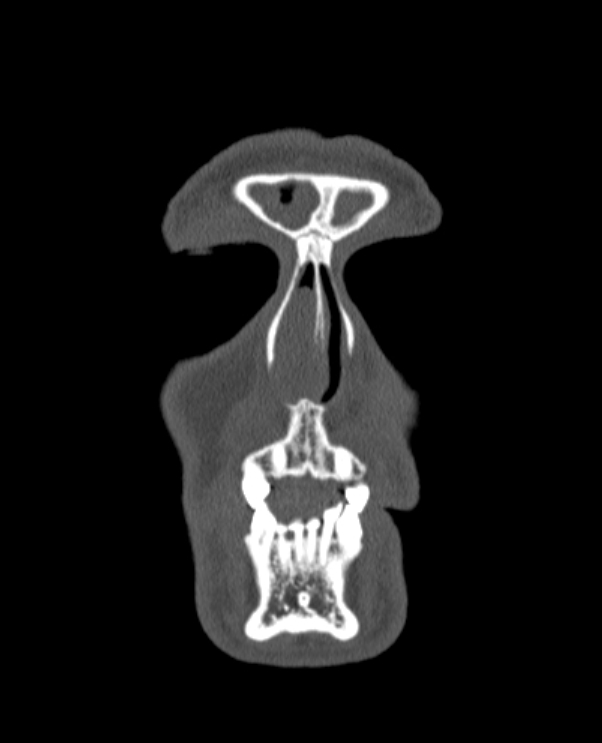 Antrochoanal polyp (Radiopaedia 79011-92169 Coronal bone window 82).jpg