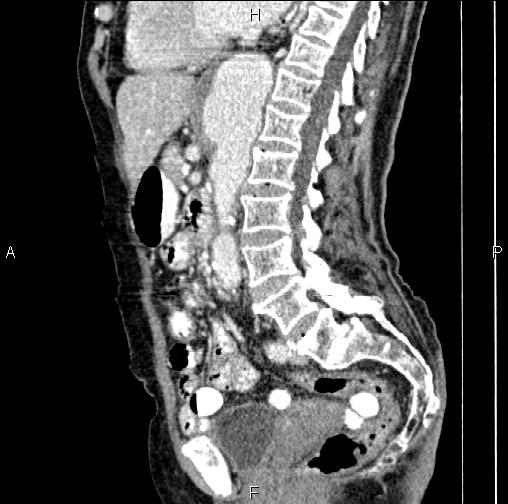 Aortic aneurysm and Lemmel syndrome (Radiopaedia 86499-102554 D 48).jpg