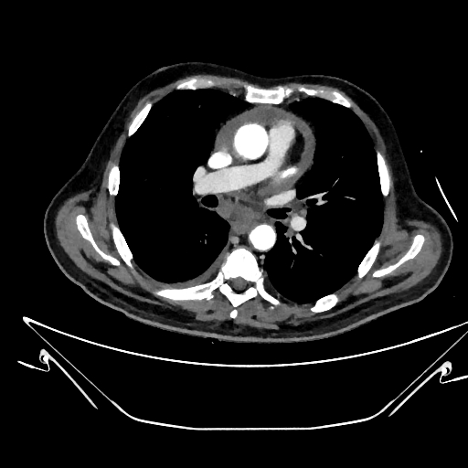 Aortic arch aneurysm (Radiopaedia 84109-99365 C 204).jpg