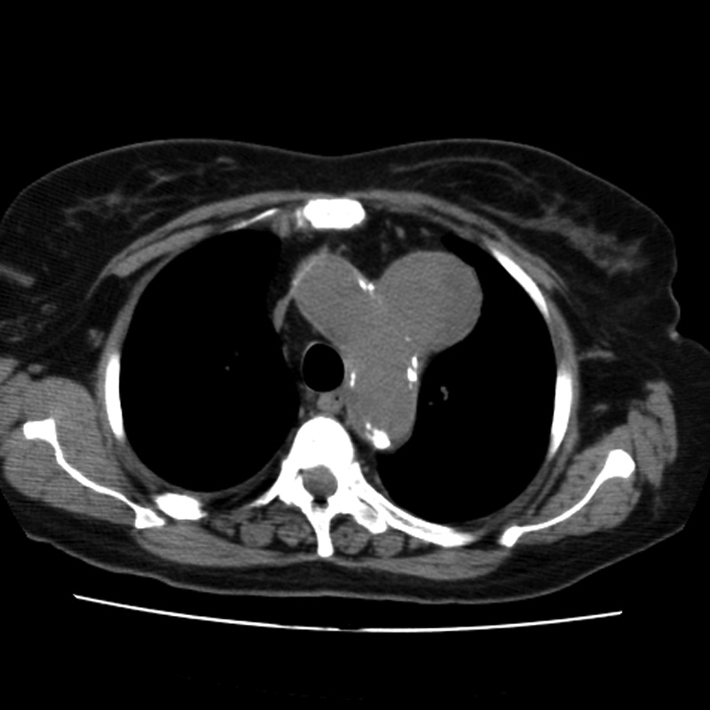 Aortic arch pseudoaneurysm (Radiopaedia 8534-9368 Axial non-contrast 20).jpg