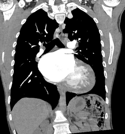 Aortic coarctation with aneurysm (Radiopaedia 74818-85828 C 67).jpg