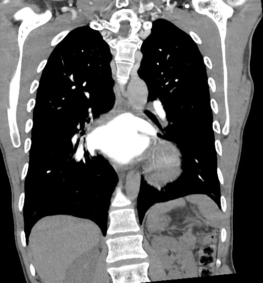 Aortic coarctation with aneurysm (Radiopaedia 74818-85828 C 76).jpg