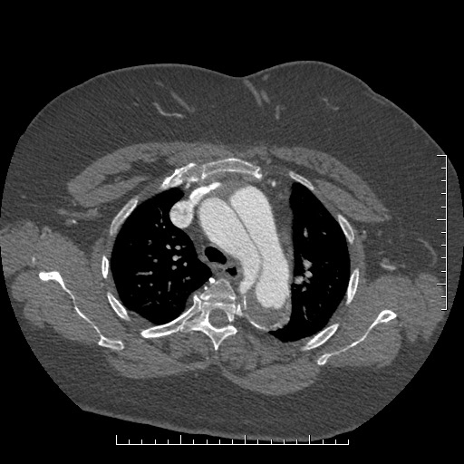 Aortic dissection- Stanford A (Radiopaedia 35729-37268 A 20).jpg
