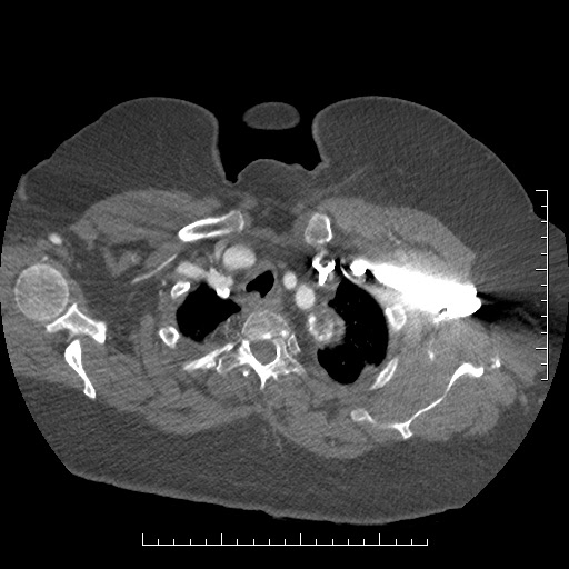 File:Aortic dissection- Stanford A (Radiopaedia 35729-37268 A 3).jpg