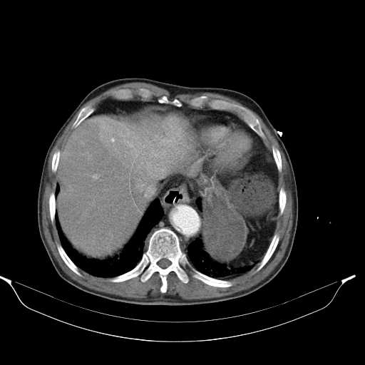 Aortic dissection- Stanford type A (Radiopaedia 22085-22085 A 34).jpg