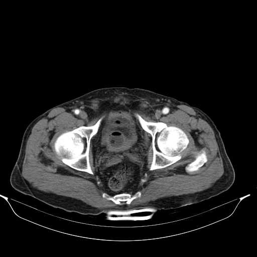 Aortic dissection- Stanford type A (Radiopaedia 22085-22085 A 77).jpg