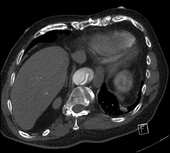 File:Aortic dissection (CTPA) (Radiopaedia 75506-86750 A 76).jpg