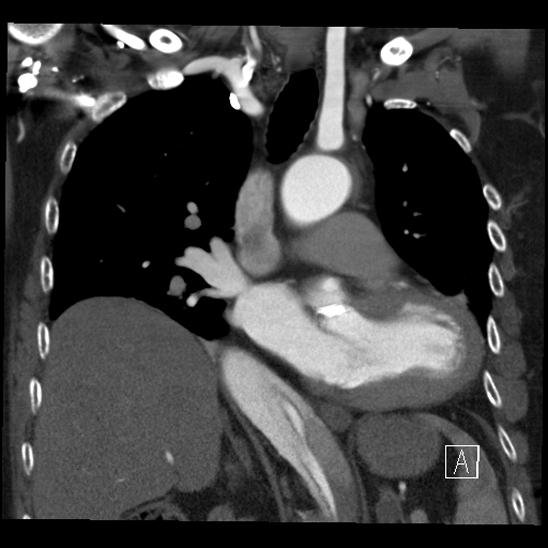File:Aortic dissection (CTPA) (Radiopaedia 75506-86750 B 33).jpg