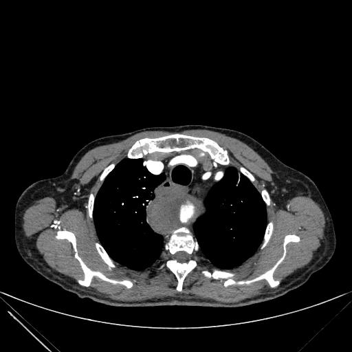 Aortic dissection (Radiopaedia 27466-27665 C+ arterial phase 14).jpg