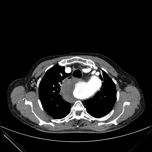 Aortic dissection (Radiopaedia 27466-27665 C+ arterial phase 25).jpg