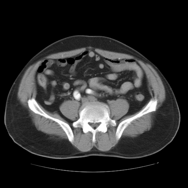 Aortic dissection (Radiopaedia 44411-48061 C 43).jpg
