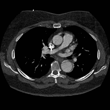 Aortic dissection (Radiopaedia 57969-64959 A 149).jpg