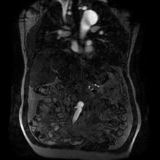 File:Aortic dissection - Stanford A - DeBakey I (Radiopaedia 23469-23551 D 111).jpg
