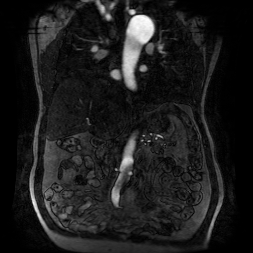 Aortic dissection - Stanford A - DeBakey I (Radiopaedia 23469-23551 D 117).jpg