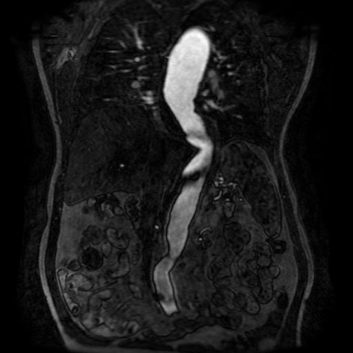 Aortic dissection - Stanford A - DeBakey I (Radiopaedia 23469-23551 D 136).jpg