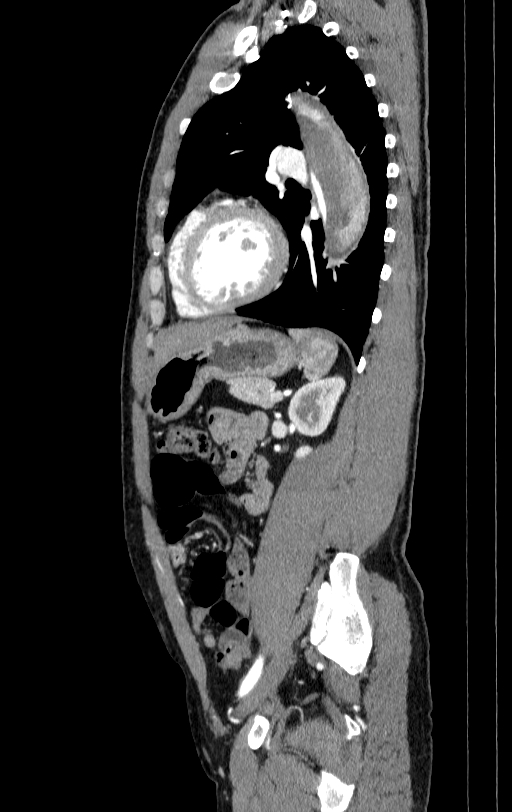 Aortic dissection - Stanford type A (Radiopaedia 83418-98500 B 64).jpg