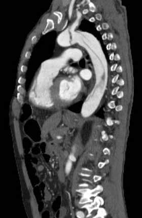 Aortic dissection - Stanford type B (Radiopaedia 73648-84437 C 64).jpg