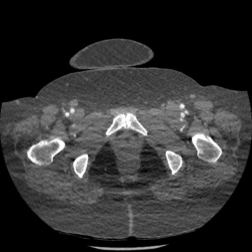 File:Aortic dissection - Stanford type B (Radiopaedia 88281-104910 A 164).jpg