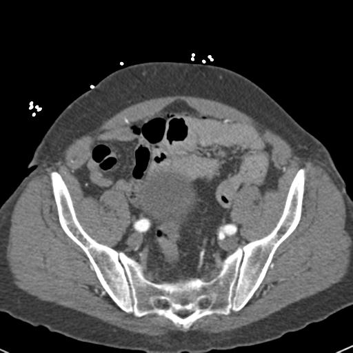 Aortic intramural hematoma (Radiopaedia 31139-31838 B 143).jpg