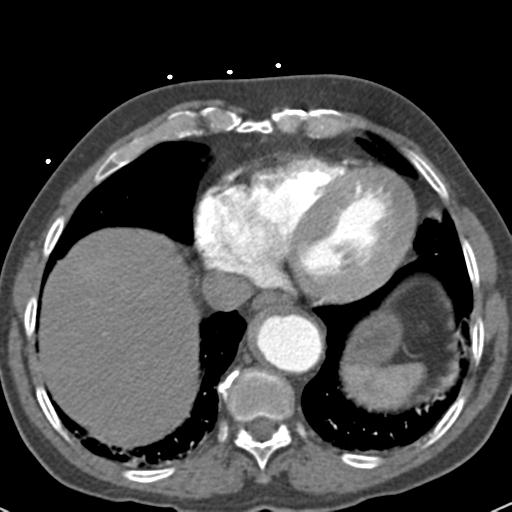Aortic intramural hematoma (Radiopaedia 31139-31838 B 66).jpg