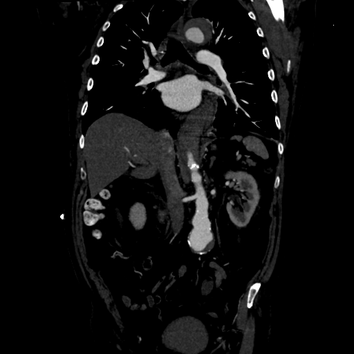 Aortic intramural hematoma (Radiopaedia 34260-35540 C 47).png