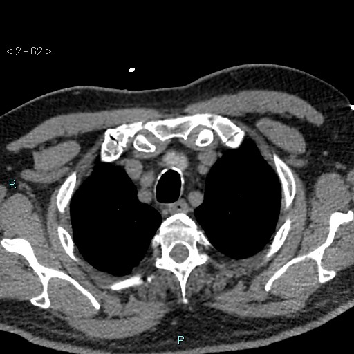Aortic intramural hematoma (Radiopaedia 48463-53380 Axial non-contrast 28).jpg