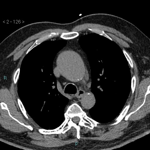 Aortic intramural hematoma (Radiopaedia 48463-53380 Axial non-contrast 56).jpg