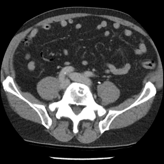 Aortic intramural hematoma (type B) (Radiopaedia 79323-92387 Axial C+ delayed 87).jpg
