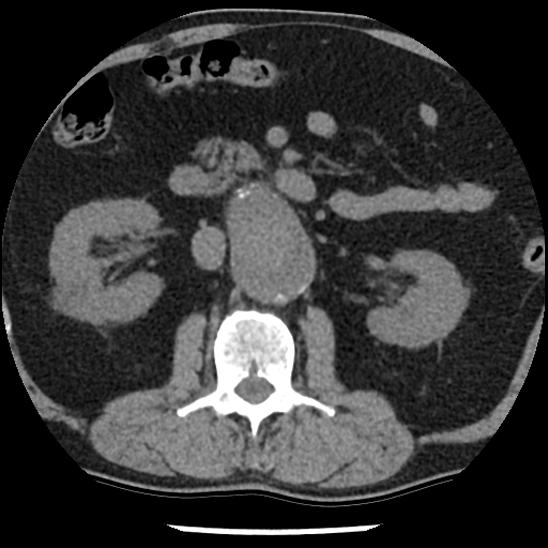 File:Aortic intramural hematoma (type B) (Radiopaedia 79323-92387 Axial non-contrast 68).jpg