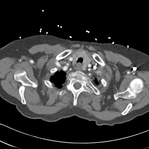 File:Aortic intramural hematoma from penetrating atherosclerotic ulcer (Radiopaedia 31137-31836 A 4).jpg