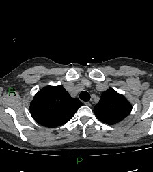 Aortic valve endocarditis (Radiopaedia 87209-103485 Axial non-contrast 21).jpg