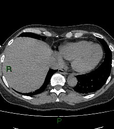 Aortic valve endocarditis (Radiopaedia 87209-103485 Axial non-contrast 79).jpg