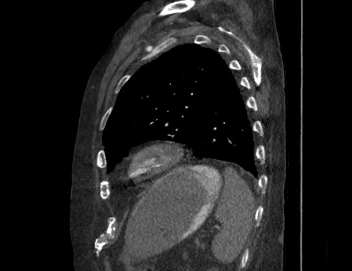 Aortoesophageal fistula with endovascular repair (Radiopaedia 73781-84592 Sagittal C+ CTPA 158).jpg