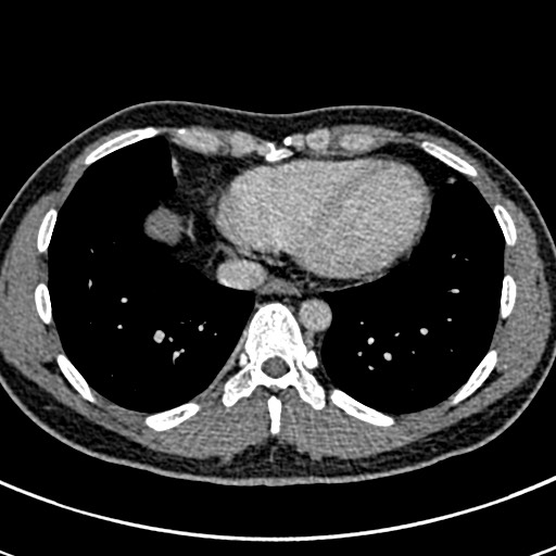 File:Apical lung mass mimic - neurogenic tumor (Radiopaedia 59918-67521 A 60).jpg