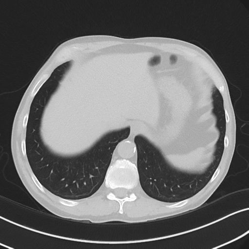 Apical pulmonary metastasis (Radiopaedia 46338-50754 Axial non-contrast 54).png