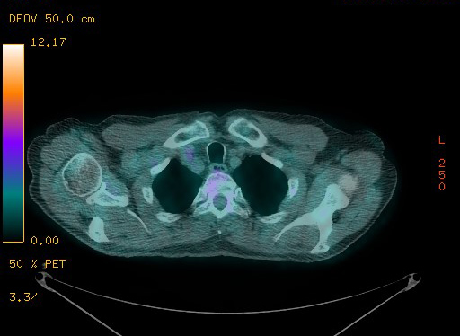 Appendiceal adenocarcinoma complicated by retroperitoneal abscess (Radiopaedia 58007-65041 Axial PET-CT 36).jpg