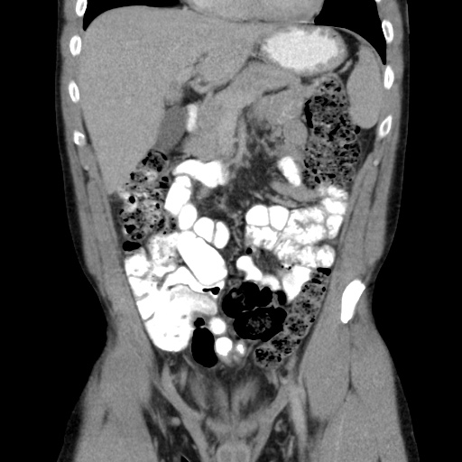 File:Appendicitis complicated by post-operative collection (Radiopaedia 35595-37113 B 21).jpg