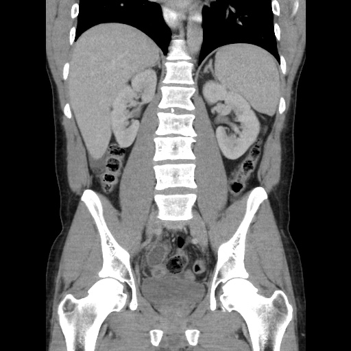 Appendicitis complicated by post-operative collection (Radiopaedia 35595-37114 B 34).jpg
