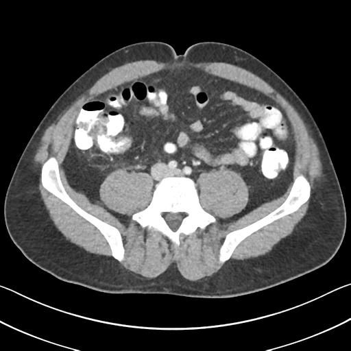File:Appendicitis with cecal bar sign (Radiopaedia 31878-32830 B 52).jpg
