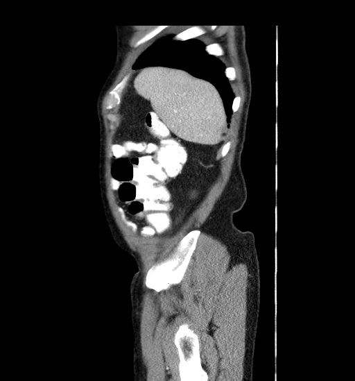 Appendicitis with localized perforation and abscess formation (Radiopaedia 49035-54130 C 9).jpg