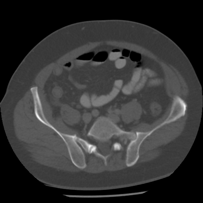 Appendicitis with perforation (Radiopaedia 35790-37342 Axial bone window 38).jpg