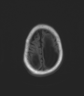 File:Aqueductal stenosis (Radiopaedia 73974-84802 Axial T1 22).jpg