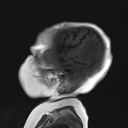 File:Aqueductal stenosis (Radiopaedia 73974-84802 Sagittal T1 2).jpg