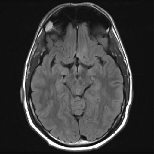 File:Arachnoid cyst - cerebellopontine angle (Radiopaedia 59689-67083 Axial FLAIR 16).png