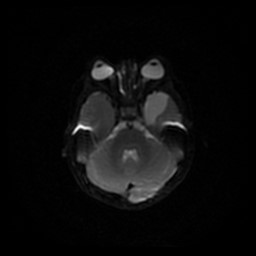 Arachnoid cyst - middle cranial fossa (Radiopaedia 86780-102938 Axial DWI 50).jpg