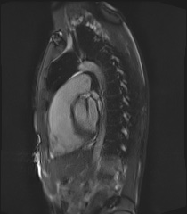 File:Arrhythmogenic right ventricular cardiomyopathy (Radiopaedia 57972-64966 Cine RVOT SSFP 3).jpg